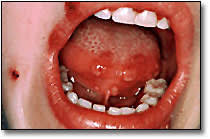 The herpes simplex virus is categorized into 2 types: Primary Herpetic Gingivostomatitis Smiles For Tomorrow Continuing Education Course Dentalcare Com