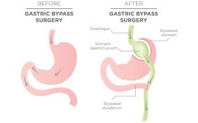 We did not find results for: Gastric Bypass Surgery In Thane Currae Hospital
