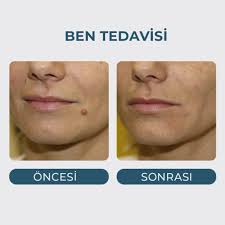 Ben (Nevüs) Tedavisi