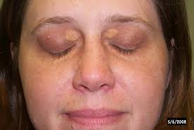 Image result for xanthelasma of eyelid