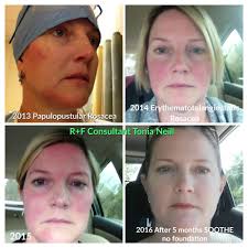 Are there any Canadian products I could use for my Rosacea?