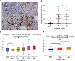 When malignant cancer cells form and grow within a person's breast tissue, breast cancer occurs. Non Apoptotic Function Of Caspase 8 Confers Prostate Cancer Enzalutamide Resistance Via Nf Kb Activation Cell Death Disease