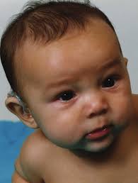 Children Referred for Speech Delays SERVICE GUIDELINE 3