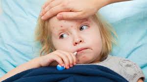 Chickenpox May Increases Kids' Risk of Stroke