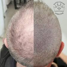 La micropigmentazione capelli deve quindi essere eseguita in. Tricopigmentazione Milano Pink Ink