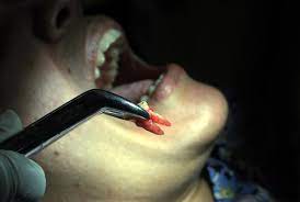 Does Getting A Tooth Pulled Hurt