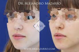 La bichectomía es un procedimiento que logra mejorar el perfil de la cara, haciéndola más perfilada y delgada. Bichectomia En Barcelona Dr Mazarro Cirugia Estetica Facial