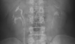 Image result for Intravenous Pyelogram