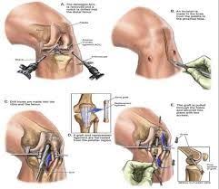 5 Things To Know When Planning Orthopedic Hip Or Knee Surgery Outpatient Surgery Can Save You Money Http Bit Ly 2fa4 Acl Surgery Acl Tear Recovery Acl Tear
