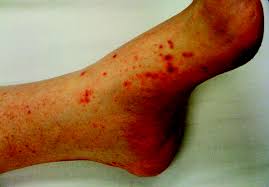 Equally, it can cause patients alarm but requires little more than. Purpura Taber S Medical Dictionary