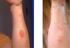 Image result for dermatitis contacta allergica
