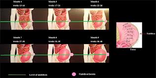 If you have a ventral hernia in the belly area, you may see or feel a bulge along the outer surface of the abdomen. Frontiers Umbilical Hernia Repair And Pregnancy Before During After Surgery