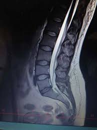 Image result for vyhřezlá ploténka