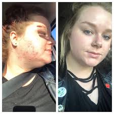 We did not find results for: Before After Goodbye Hormonal Acne And Scarring May 2018 Vs May 2019 Skincareaddiction