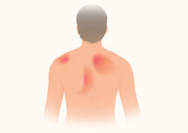 The human back, also called the dorsum, is the large posterior area of the human body, rising from the top of the buttocks to the back of the neck. Pain In And Under The Shoulder Blade Your Guide To Pain Relief