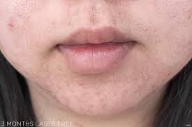 Your skin cells react by boosting collagen and elastin to repair it. Tria Hair Removal Laser 4x 3 Months Laser Free Lavenderlilac Dream
