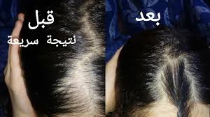 شعرك فارغ يتساقط خفيف البرهان قدامكم والله معجزة وسريعة youtube grow hair faster grow hair hair