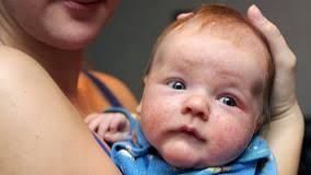 This means that the early detection of skin cancer can be tricky. Baby Or Infant Eczema Causes Symptoms Treatment Everyday Health