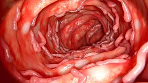Image result for Ulcerative Colitis