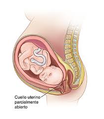 Maybe you would like to learn more about one of these? Que Es El Trabajo De Parto Prematuro