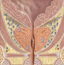 Since 1999 we have successfully implanted gold markers in 705 patients. Technique For Implantation Of Fiducial Markers In The Prostate Urology