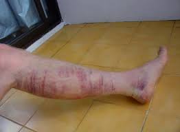 Este posibil să fie necesară o operație de eliminare a hematoamei. Ce Este Hematomul