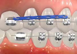 Dental implants are surgical fixtures placed in the jawbone, which then fuse with the jawbone over a few months. Orthodontic Appliances Texas Orthodontic Specialists