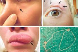 Sesetengah spesies tidak menimbulkan bahaya tertentu dan agak mudah dirawat. Ada Cacing Bergerak Di Dalam Kulit Perempuan Ini Apa Yang Terjadi Halaman All Kompas Com