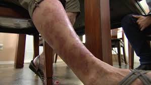 Georgia student suffers 3rd degree burns in high school lab experiment