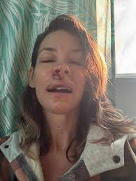 Evangeline Lilly Shares Photos After Fainting, Hitting Her Face