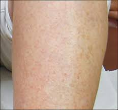 The initial signs of senile purpura are purple or red bruises that have an irregular shape. An Unusual Petechial Rash Photo Quiz American Family Physician