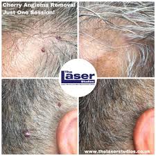 Sometimes cherry hemangiomas are more purple than red in color. Facebook