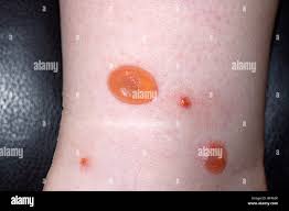 Image result for Trombicula autumnalis