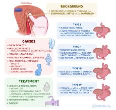 Image result for stomach hernia symptoms