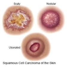 According to the national cancer. Squamous Cell Carcinoma Discharge Care What You Need To Know