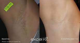 Laser hair removal is a treatment using clinically proven diode laser technology to permanently reduce unwanted hair comfortably and effectively after completion of a treatment series. Professional Laser Hair Removal By Medical Professionals On The North Shore