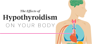 The symptoms of thyroid cancer are typically subtle. Effects Of Hypothyroidism Thinning Hair Heart Attack And More