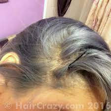 What you use in the shower makes just as big of a difference in your scalp's health and irritation. Are These Chemical Burns Forums Haircrazy Com