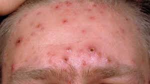 Rasa tertekan dengan kesan parut jerawat dan sudah buntu? Tak Sangka Cara Hilangkan Parut Chicken Pox Ni Menjadi Kedai Vitamin Butterworth