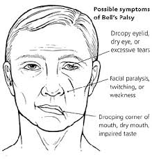Bell's palsy is a weakness (paralysis) that affects the nerve fibres that control the muscles of the face. Best Treatment For Bell S Palsy In Greater Toronto Area