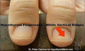 Do You Have Hypothyroidism Look At Your Hands Thyroid Symptoms Health Signs Nail Health Signs