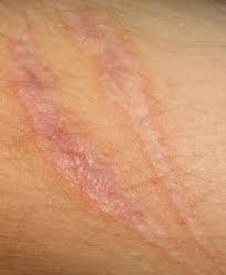 Bio Oil Before And After Burn Scars Pin On Tha 210 Cuts Scars And Bruises