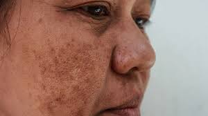 Image result for Melasma