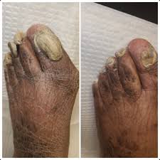 Image result for diabetic toes