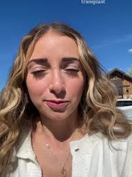 Brooklyn and Bailey Dakota Hair Transplat