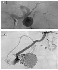 Gas embolotherapy is a twist on traditional catheter based embolotherapy approaches. Visceral Artery Aneurysms Intechopen