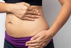 Fastest Way To Get Rid Of Stretch Marks: Causes, Prevention