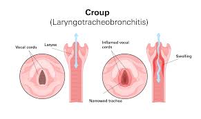 Image result for Croup