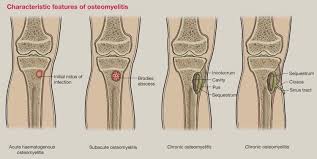 Image result for Osteomyelitis