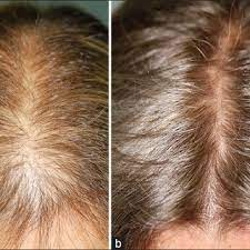 But ive read somewhere that propecia has a better shelf life because of its casing. Finasteride 5 Mg Day Treatment Of Patterned Hair Loss In Normo Androgenetic Postmenopausal Women